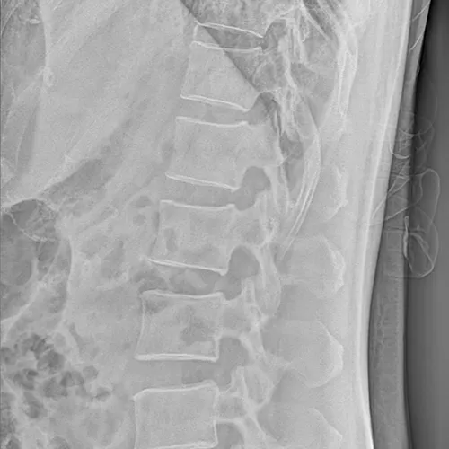 Spinal  radiograph