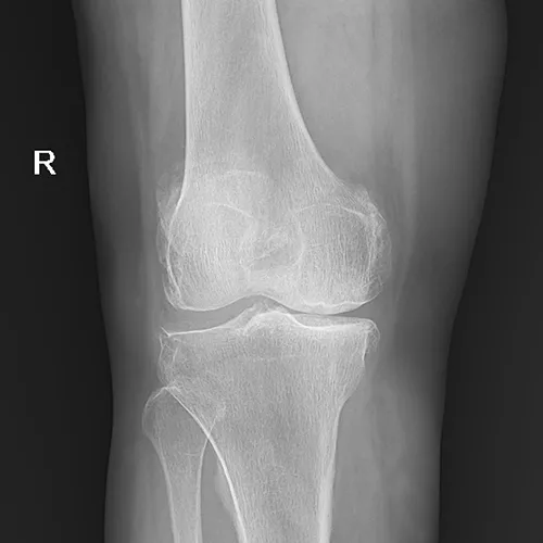 Limb radiograp