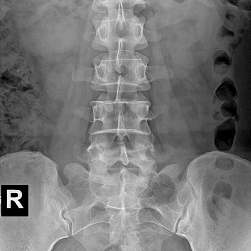 Abdominal radiograph