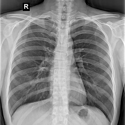 Chest radiograp
