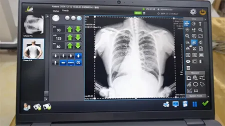 ANGEL Portable Digital X-Ray Machine
