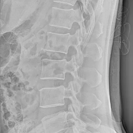 Spinal  radiograph