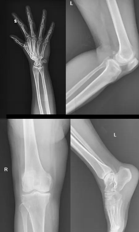 Limb radiograph
