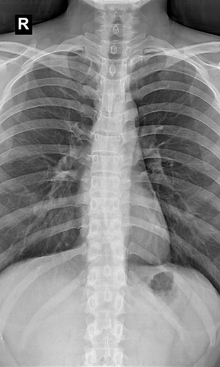 Chest radiograph