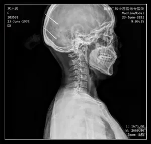 Ceiling-Mounted X-Ray Machine