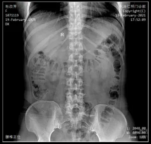Ceiling-Mounted X-Ray Machine
