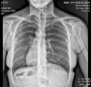 Ceiling-Mounted X-Ray Machine