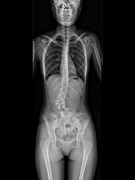 Long Bone Stitching radiograph