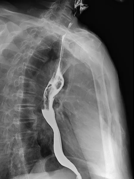 Esophagus radiograph