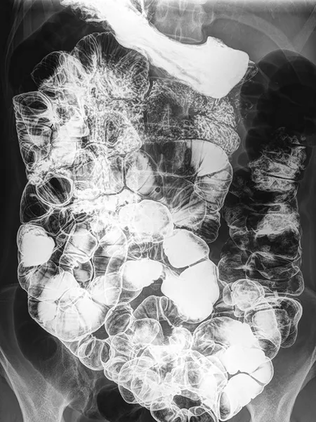 Small Intestine radiograph