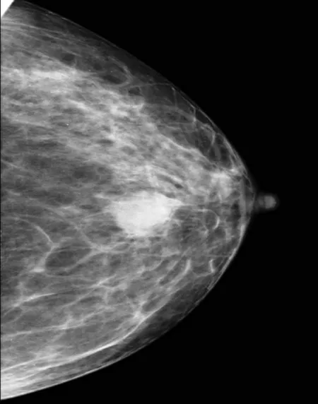 An image of a tumor